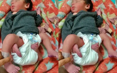 जिले में जन्मा  4 हाथ और 4 पैर वाला अनोखा बच्चा