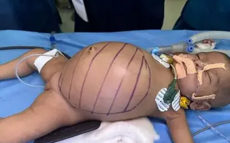 Lucknow: 5 किलो वजन- 3 महीने की उम्र- पेट में था डेढ़ किलो का ट्यूमर फिर क्या..