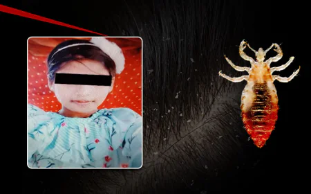 सिर में जुओं ने ली 12 साल की बच्ची की जान