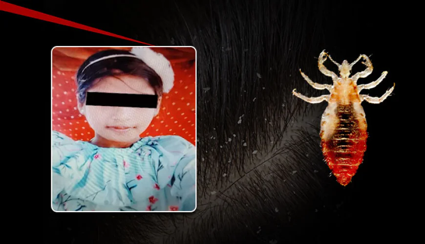 सिर में जुओं ने ली 12 साल की बच्ची की जान